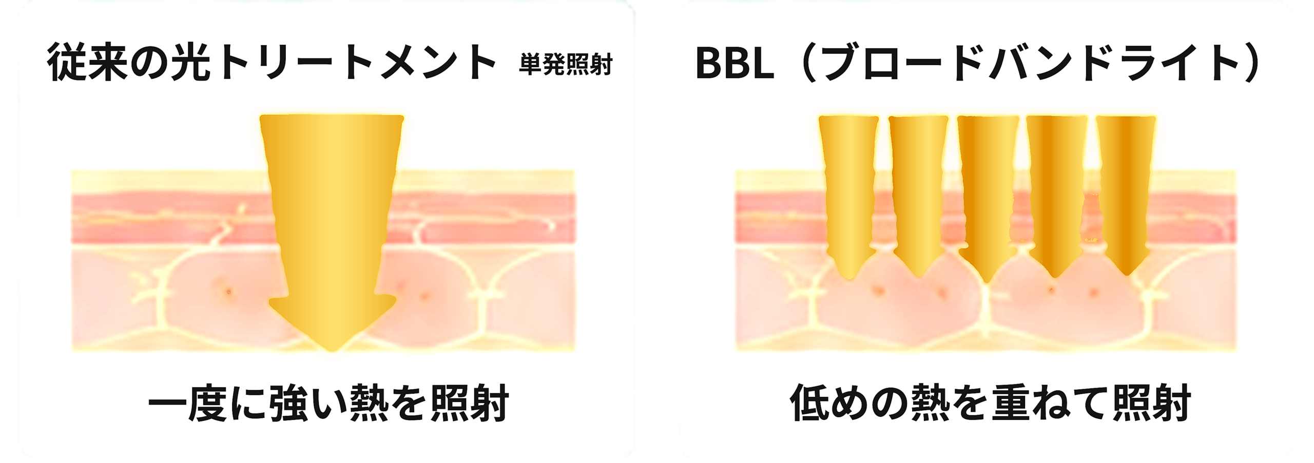 従来の光トリートメントの照射方法