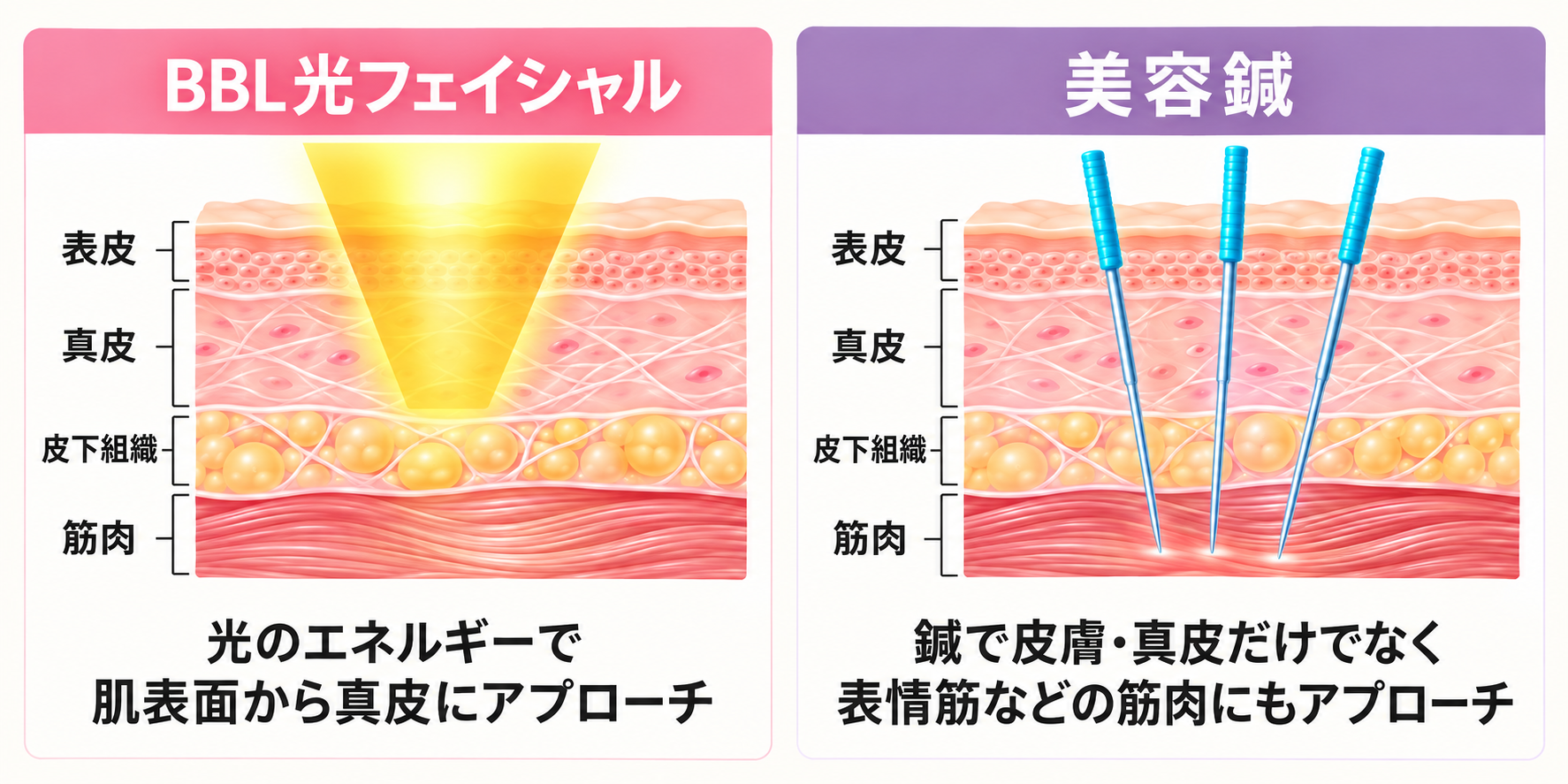 BBL光のアプローチ