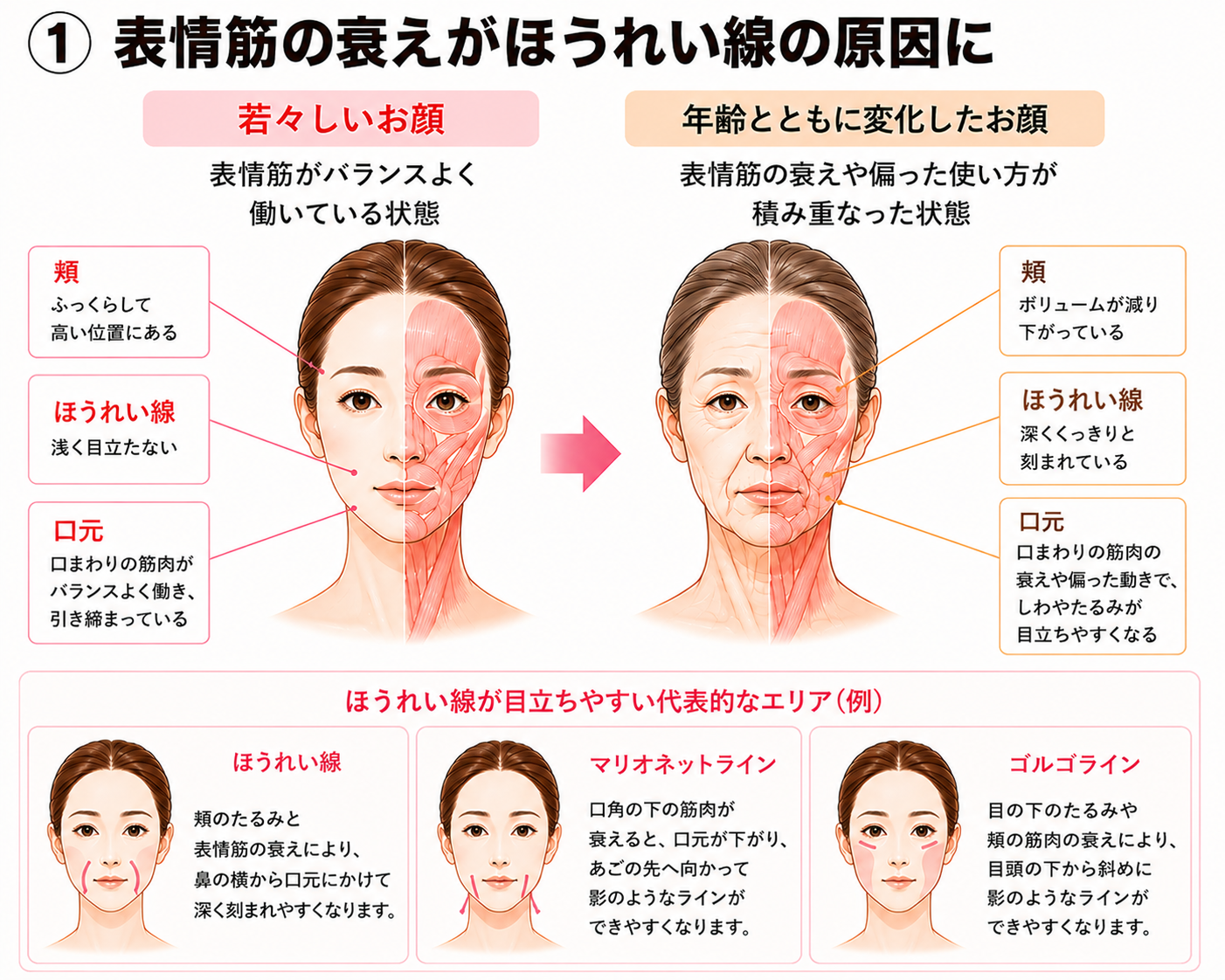 表情筋の衰えと3つのラインが目立ちやすい部位を示す図解