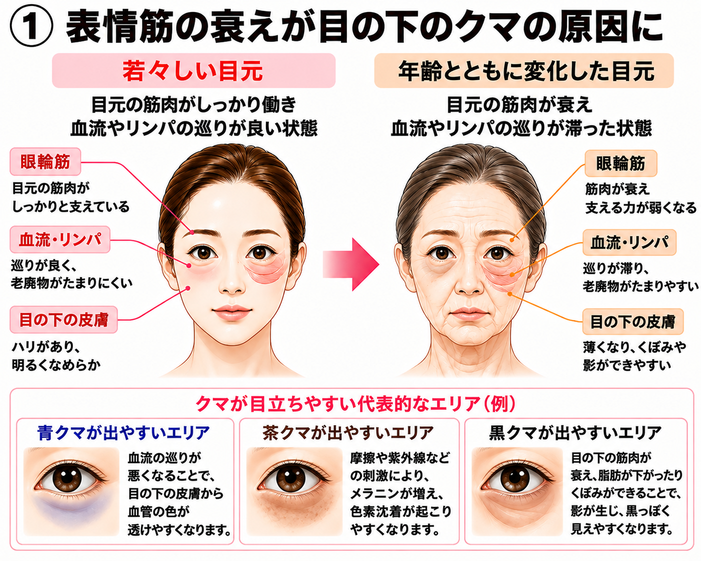 若々しい目元と年齢とともに変化した目元を比較し、目の下のクマが目立つ代表的な状態を示す図解